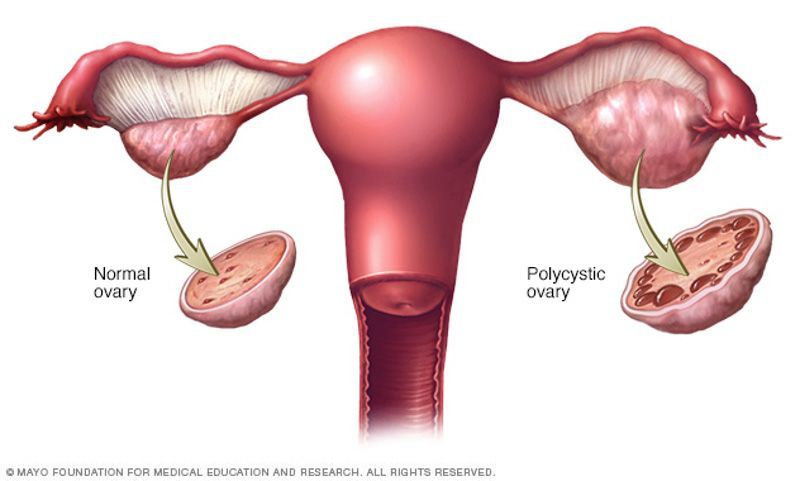 4. Sindrom ovarium polikistik