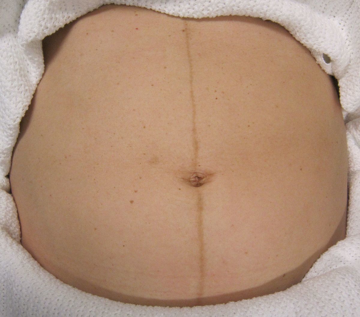 1. Muncul linea nigra atau garis hitam perut