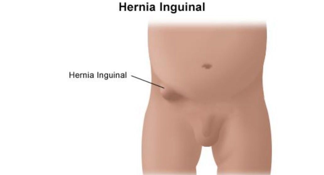 Hernia alat kelamin (inguinalis)