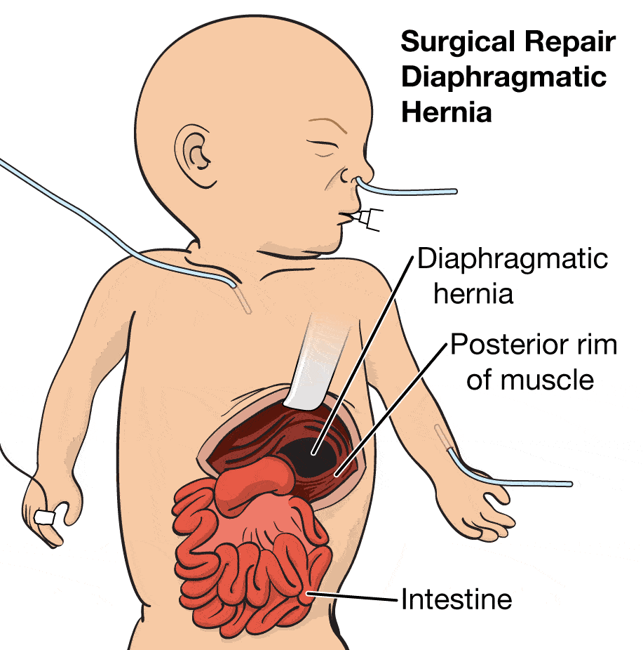 Hernia rongga diafragma