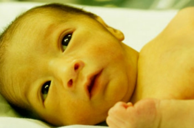 Kenapa Bayi Kuning Perlu Fototerapi