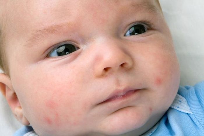 Mama Harus Tahu, ini 10 Penyebab Bayi Lebih Mudah Kena Alergi
