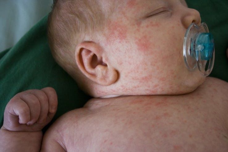 10 Alasan Kenapa Bayi Saat ini Lebih Rentan Mengalami Alergi