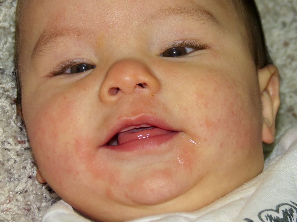 Waspada Ma, Ini 5 Tanda Bayi Mungkin Memiliki Alergi Tertentu