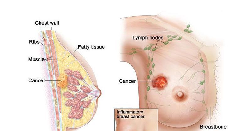 Gejala kanker payudara