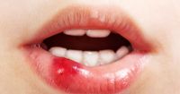 3. Mengalami luka atau trauma bagian dalam sekitar mulut