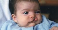 3. Komplikasi dapat terjadi bayi sumbing