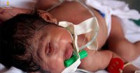 Cara Mencegah Terjadi Kelahiran Bayi Bermata Satu Alias Cyclopia