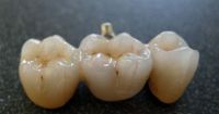 5. Dental Crown & Bridges