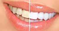 2. Teeth Whitening
