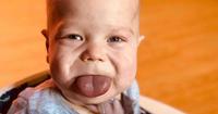2. Tanda-tanda sindrom Beckwith-Wiedemann anak