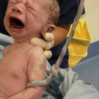 Ketahui Penyebab, Gejala, Cara Mengatasi Bayi Terlilit Tali Pusar