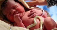 1. Apa dimaksud sindrom leher bayi terlilit tali pusar