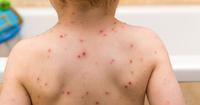 2. Chickenpox