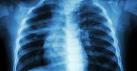 Perbedaan Tuberkulosis Orang Dewasa Tuberkulosis Anak
