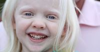 Inilah Cara Merawat Membimbing Anak Albino