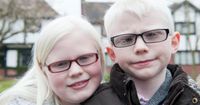 3. Penderita albino rentan terhadap kanker kulit