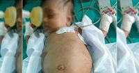 3. Fetus in fetu bayi berusia 3 bulan sukses dikeluarkan