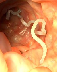 4. Infeksi parasit Schistosomiasis atau cacing pipih