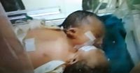 Bayi Perempuan Brebes Lahir Dua Kepala Satu Jantung