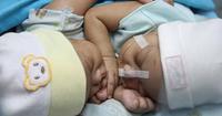 Cara Diagnosis Kembar Siam