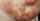 2. Jenis-jenis impetigo