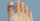 5. Sindrom kaki biru penyebab pembuluh darah tersumbat
