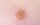 4. Spitz nevus