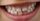 1. Muncul bintik putih dapat menunjukkan kerusakan gigi