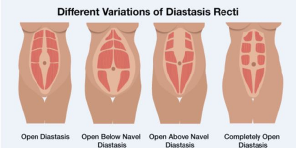 Jangan abaikan Diastasis Recti‼️ Diastasis Recti bukan hal sepele! Terutama  untuk Bunda pasca melahirkan, penting untuk menget