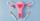 2. PCOS