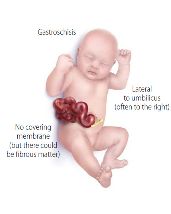 Gastroschisis, Kondisi Organ Bayi Berkembang di Luar Tubuh