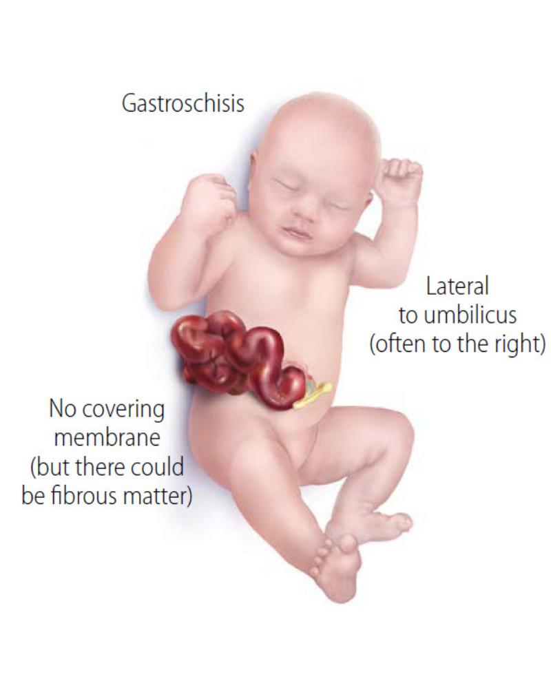 Gastroschisis, Kondisi Organ Bayi Berkembang di Luar Tubuh
