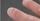 3. Onycholysis