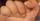 4. Onychomadesis