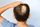 3. Jenis-jenis Alopecia