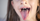3. Lidah berpulau (geographic tongue)