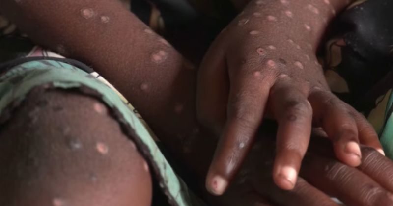 Gejala Mpox Penanganannya