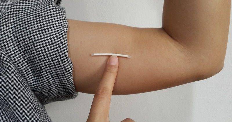 KB implan sering jadi solusi pasangan suami istri untuk membatasi jumlah anak. - skata.info