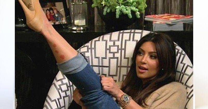 Kim Kardashian mengalami psoriasis di kaki - taringa.net