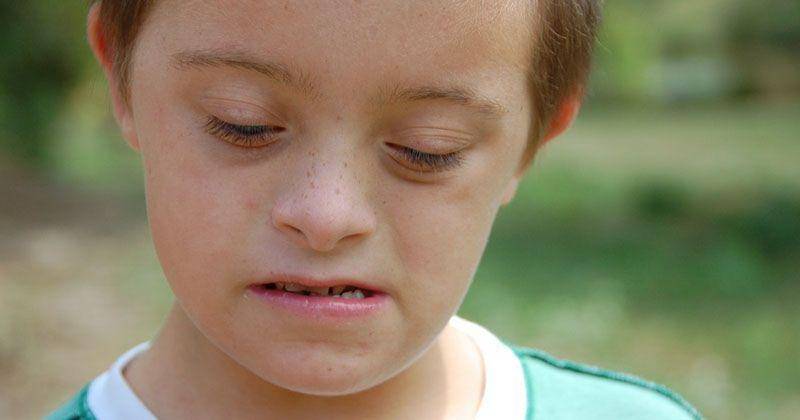 Salah satu kelainan bawaan yaitu Down Syndrome - Flickr.com/John Rousseau