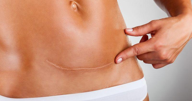 Masalah Keloid yang Timbul setelah Operasi Caesar