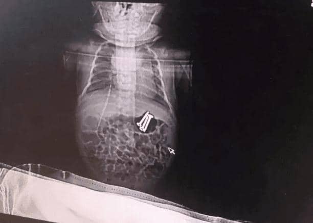 Foto rontgen sekrup di lambung bayi. - Asiawire