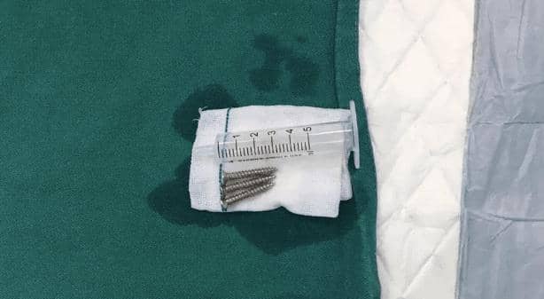 Sekrup yang dikeluarkan dari dalam perut Si Bayi. - Asiawire