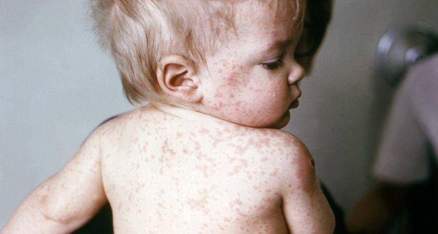 penyakit campak pada bayi - sciencenewsforstudents.org