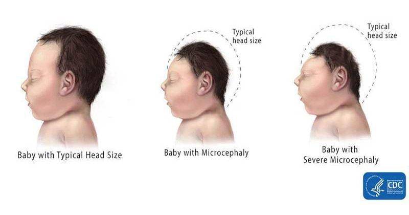 Ukuran kepala bayi mikrosefali - cdc.gov