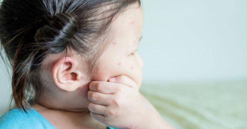 Manfaat kemiri untuk keluarga - parinyabinsuk via Getty Images/huffingtonpost.ca https://www.huffingtonpost.ca/2017/05/15/baby-mosquito-bites_n_16619312.html