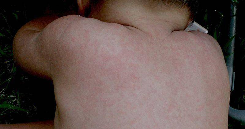 Bahaya Roseola Infantum! Ini Fakta tentang Si Bercak Merah 