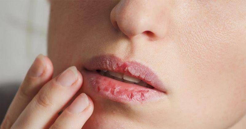 8 Cara Ampuh Mengatasi Bibir Kering saat Puasa, Terapkan Yuk!