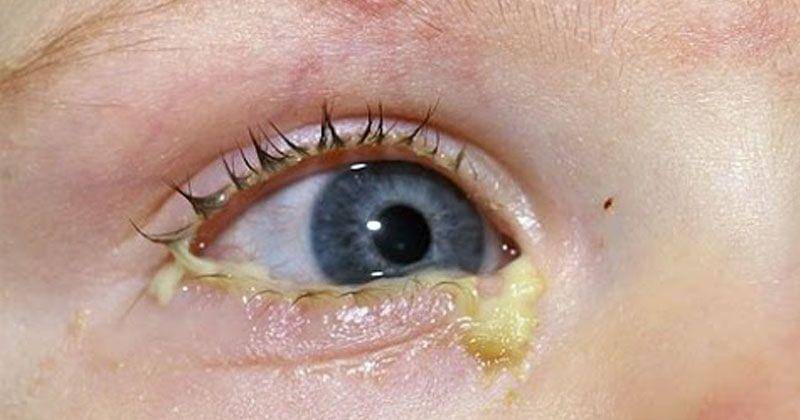 YouTube.com/the acne channel